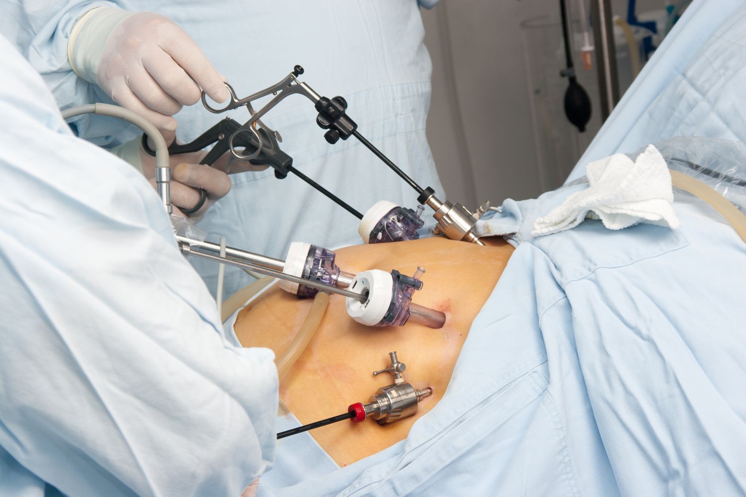 Gastric Bypass Surgery: What You Should Know Before Considering It